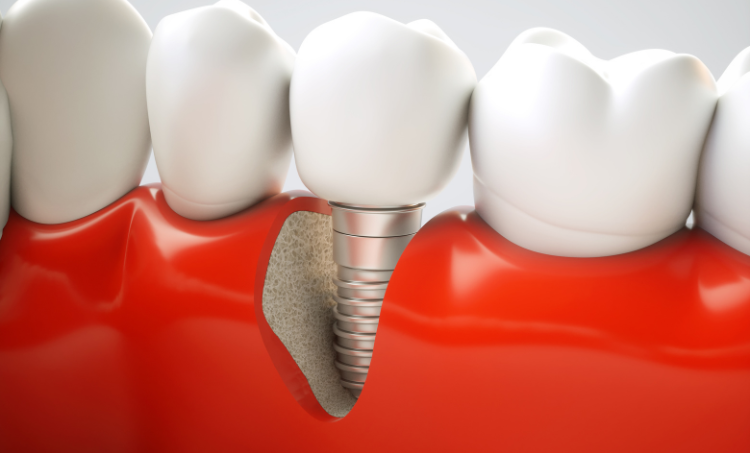 Dental Implants in Las Vegas